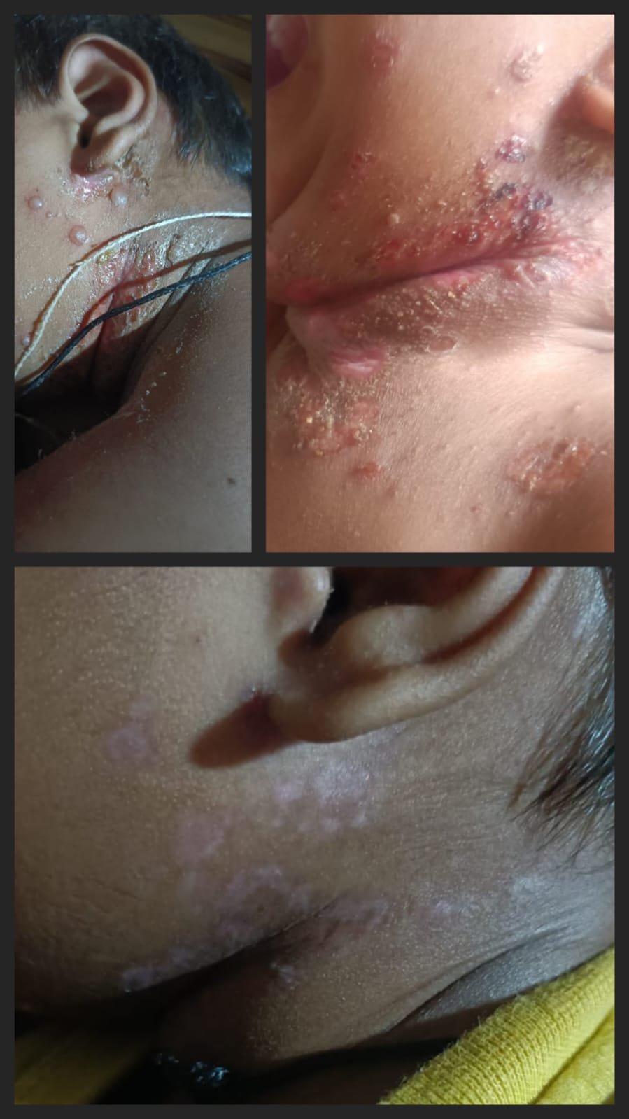 Impetigo infection treatment